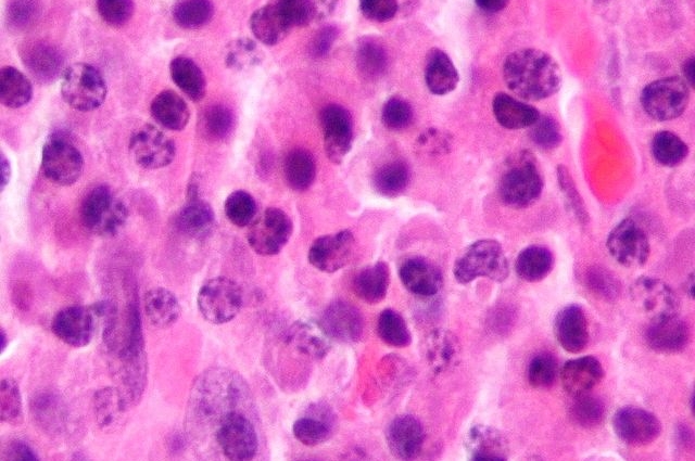 На микрофотографии показаны злокачественные плазматические клетки при миеломе. 