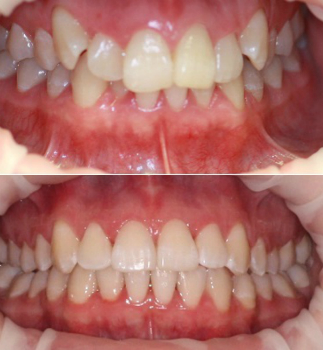 ДО и ПОСЛЕ: исправление прикуса и выравнивание зубов с помощью металлических брекетов.