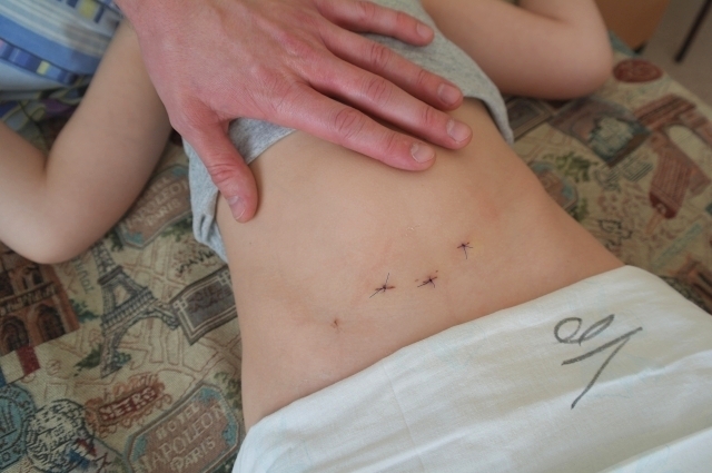 Вместо шва после операции у мальчика останутся лишь три маленькие точки.