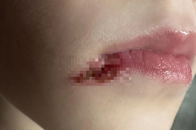 Ожог у Андрея.