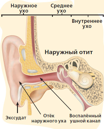 Попадание воды в ухо – первая помощь взрослым и детям — клиника «Добробут»