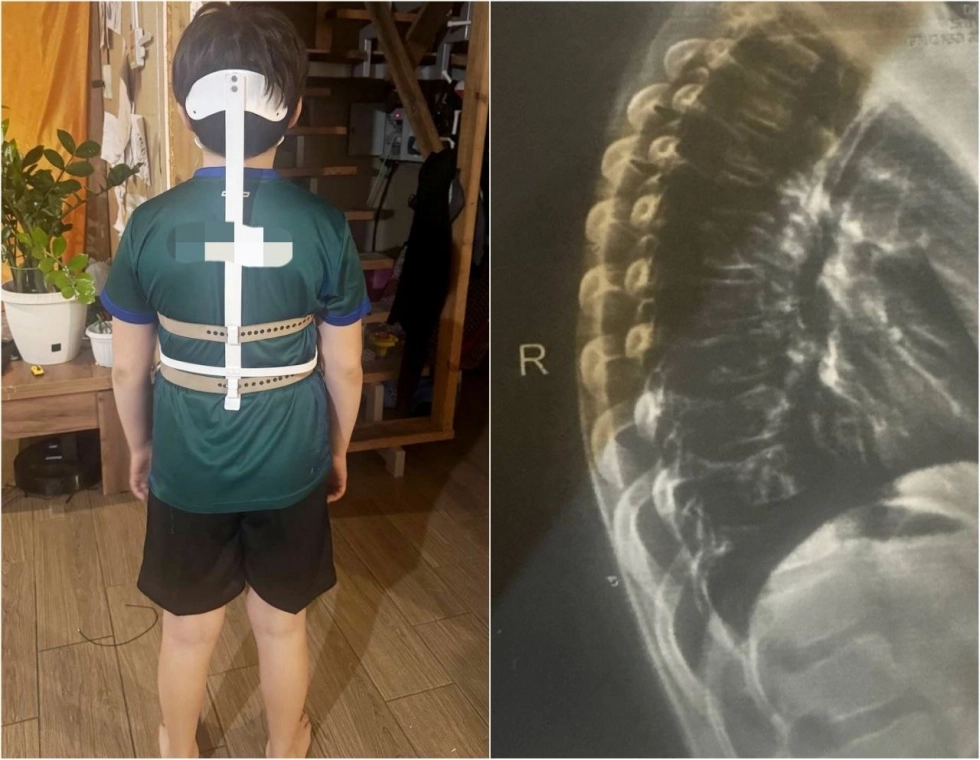 Мальчику придется четыре месяца носить специальный корсет.