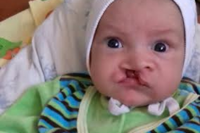 Денису поставили диагноз врождённая и сквозная расщелина губы, твёрдого и мягкого нёба и альвеолярного отростка с деформацией хрящевого отдела носа.