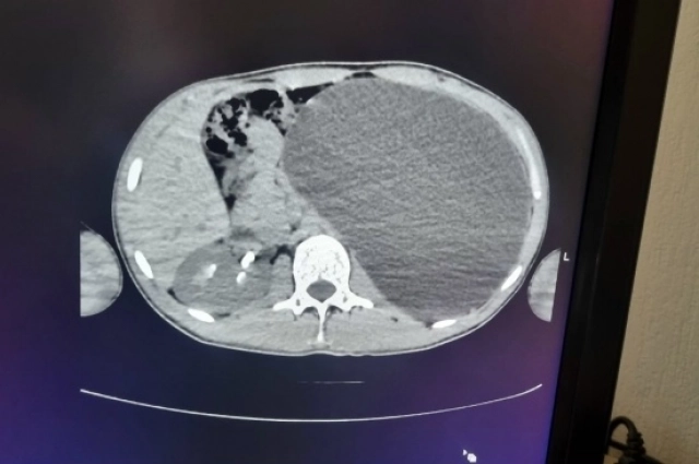 Всё, что серое - воспалённая почка
