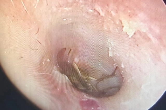 Таракан застрял в ушном проходе 