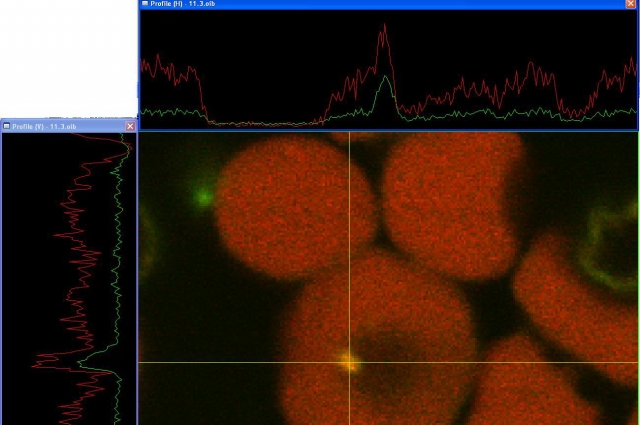 Бактерии, расположенные внутри эритроцитов в образце крови больного. Фото, сделанное с помощью конфокального лазерного сканирующего микроскопа. Зеленый – бактерии. Красный – эритроциты. 