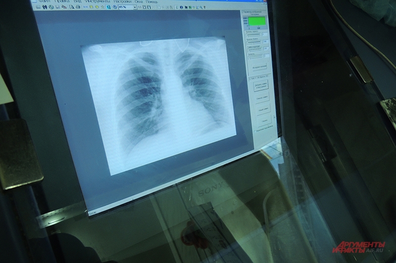 Так выглядят на флюорографии лёгкие здорового человека.