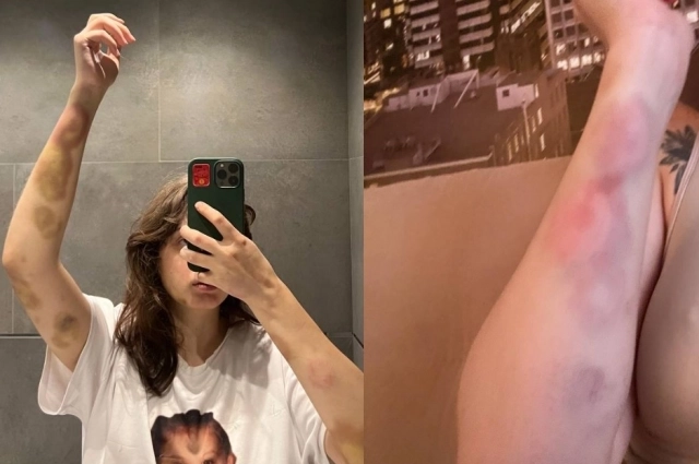 Алексей избивал Валерию до синяков и кровоподтеков.