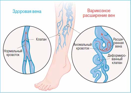 «Варикоз сам не пройдёт». Почему вздуваются вены