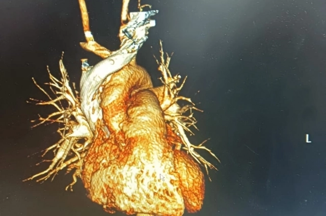 В результате удара у Аркадия возникла аневризма грудной аорты.