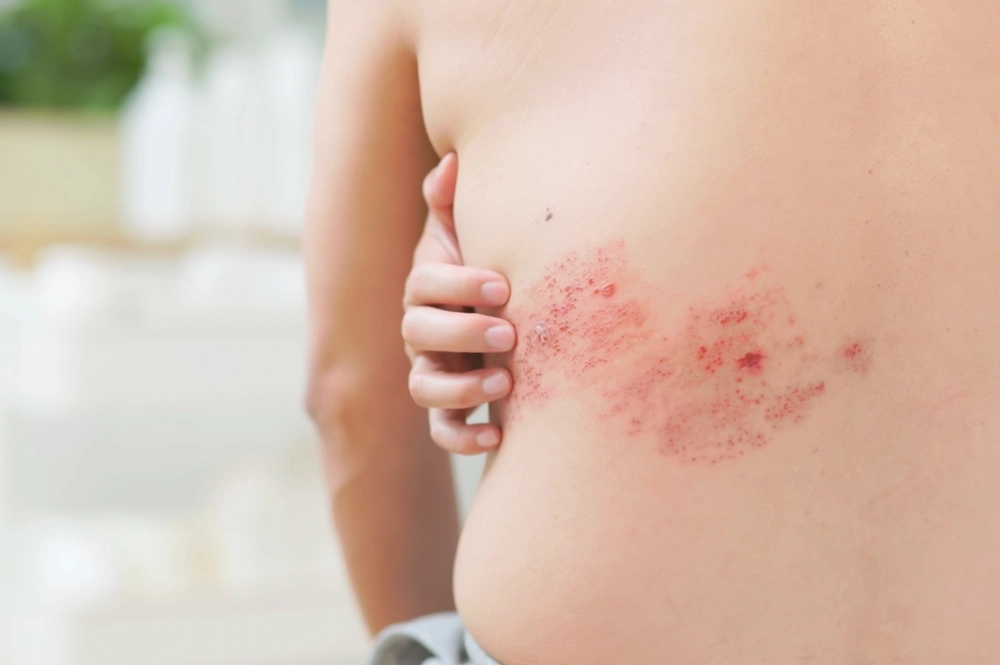 Опоясывающий лишай.