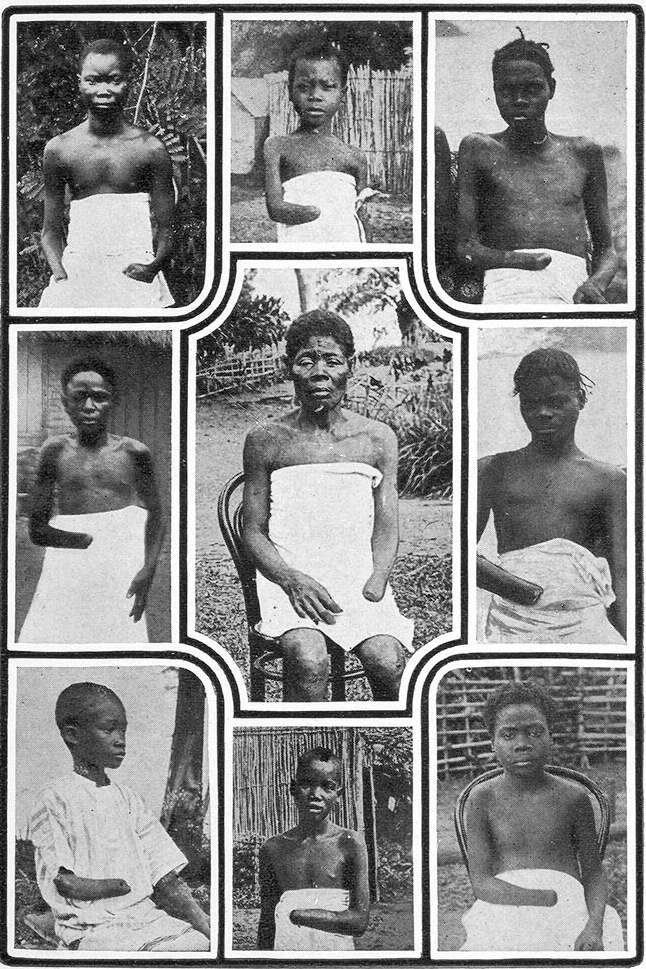 Изувеченные дети - жертвы политики Леопольда в Конго.
