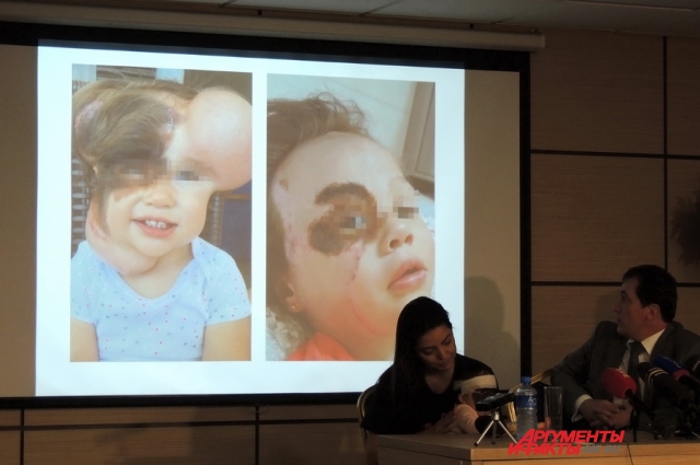 Врач Павел Попов показывает фото другой девочки из США после 4 лет лечения невуса классическим методом.