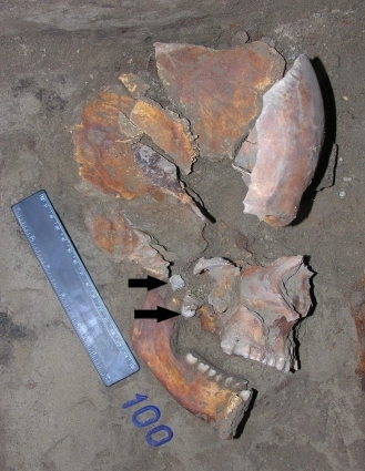 Мужчина, 25-30 лет. Кости черепа с железным наконечником стрелы и свинцовыми пулями под верхней челюстью