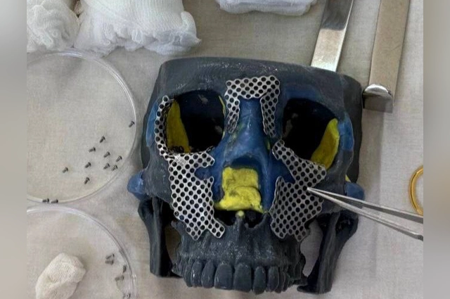Для восстановления челюсти на 3D-принтере создали макет лица.