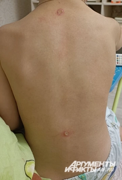 Ожоги заживают, а вот пережитый страх малыш забудет нескоро.