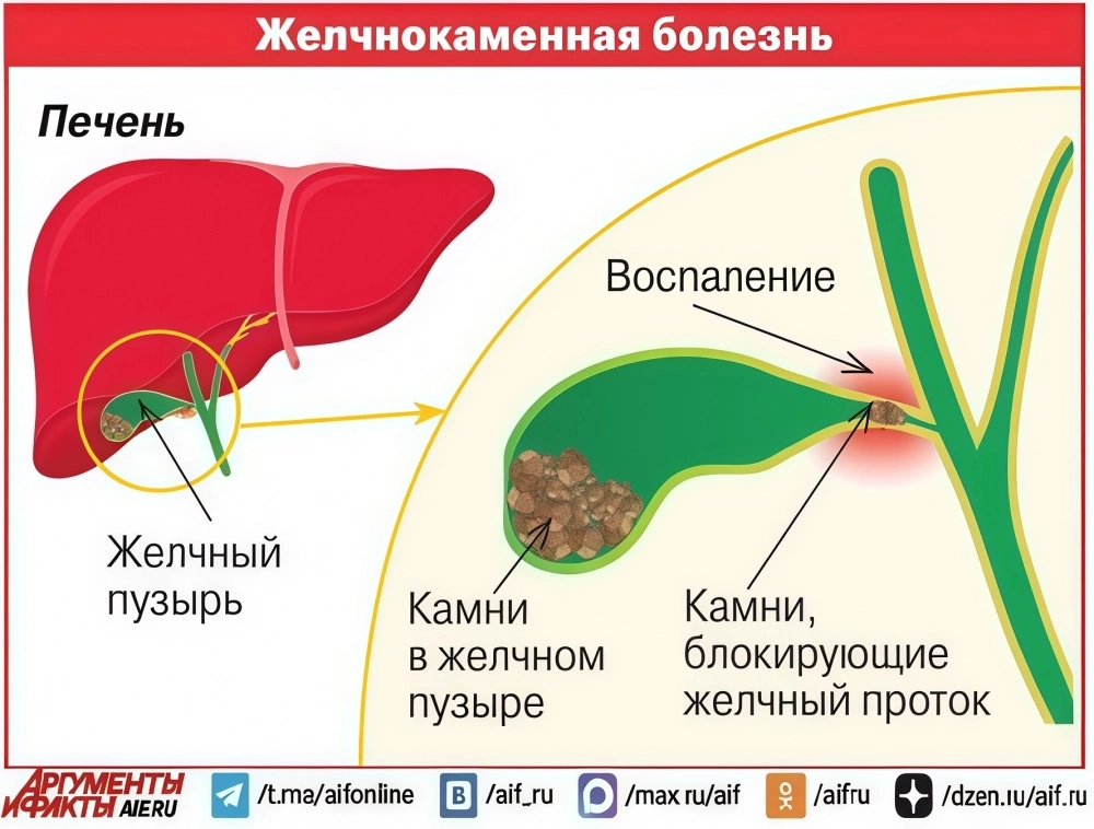 
        Жирная еда и диеты. Что приводит к желчнокаменной болезни    