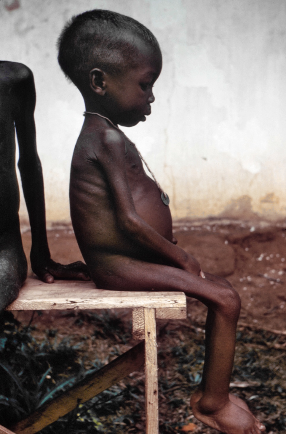Фотография африканской девочки, страдающей квашиоркором