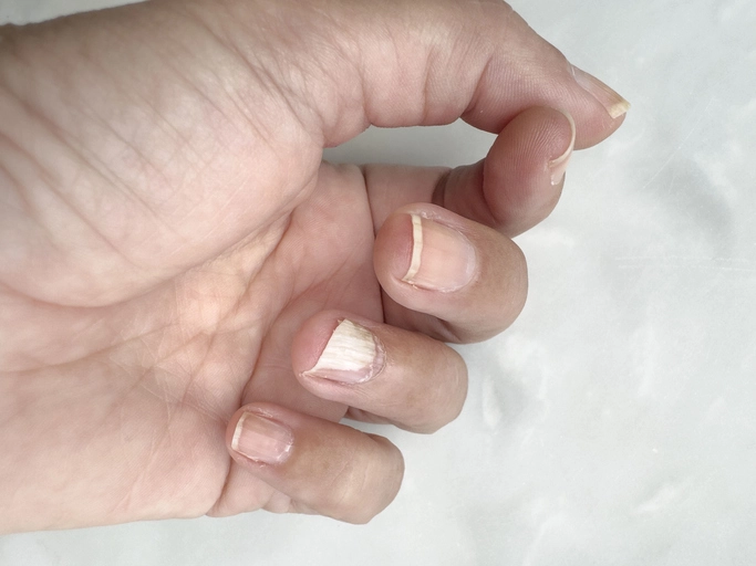 Одной из наиболее частых медицинских причин считается железодефицитная анемия.