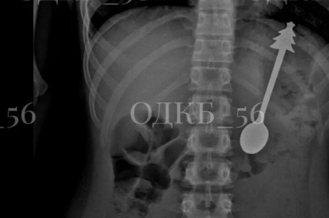 Ложка длиной в 14 сантиметров в животе у ребёнка.