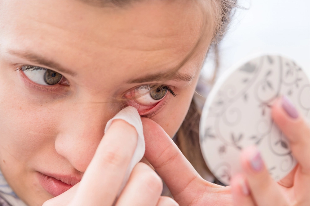 конъюнктивит