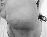 Опухоль на лице у женщины весила 1,5 кг.
