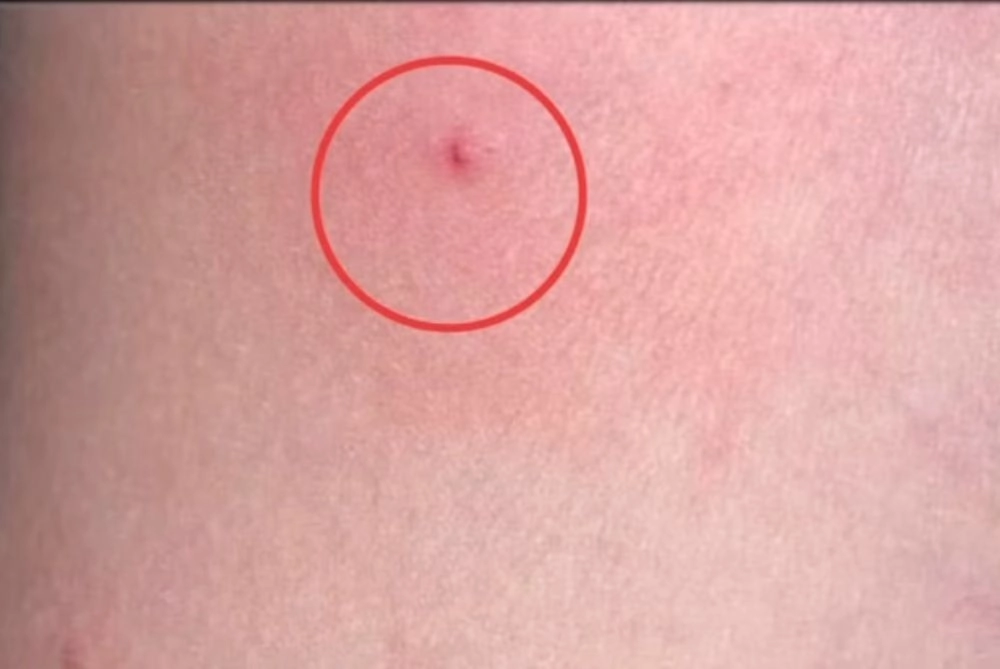 След от укола.