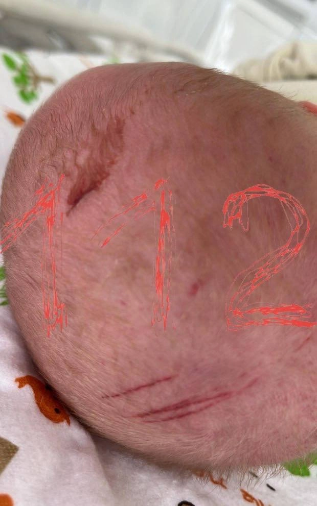 Раны на голове новорожденного