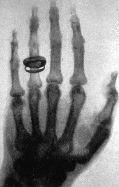 Снимок руки Альберта фон Кёлликера, сделанный Рентгеном 23 января 1896 года.