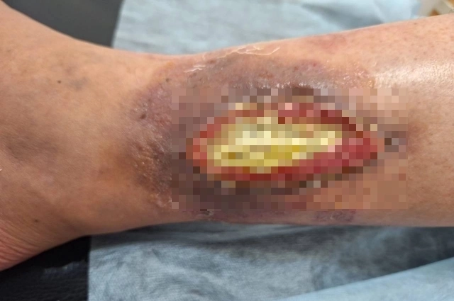 С такими серьезными осложнениями мужчина попал в Нижнекамскую центральную районную больницу, где врачи ужаснулись масштабом поражения.