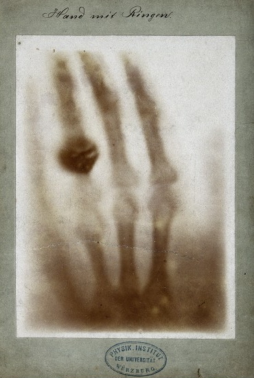 Первый рентгеновский снимок