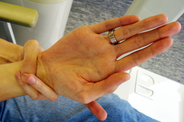 Рука человека с синдромом Марфана.