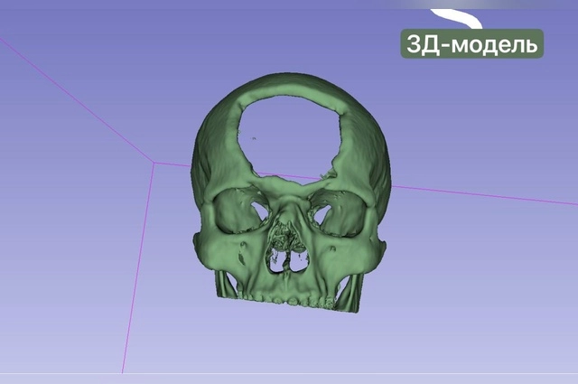 В результате ранения он получил серьезную травму головы.