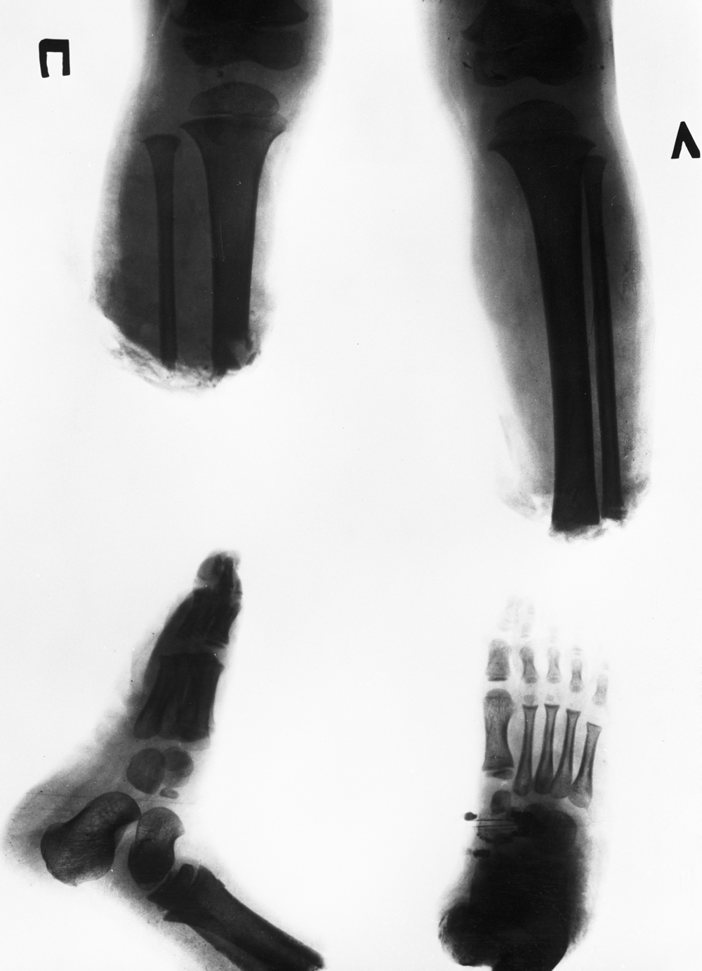 Рентгеновский снимок ног 3-летней литовской девочки Расы Прасцявичуте до операции по реплантации обеих стоп ног.