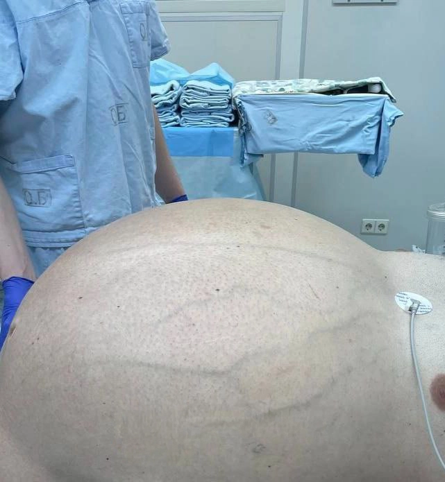 С такой огромной опухолью хирурги имели дело впервые.