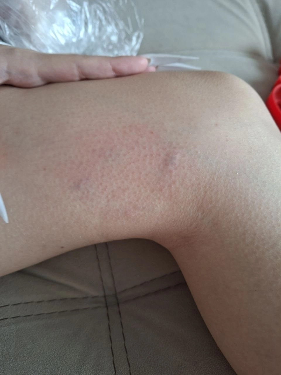 нападение собаки 