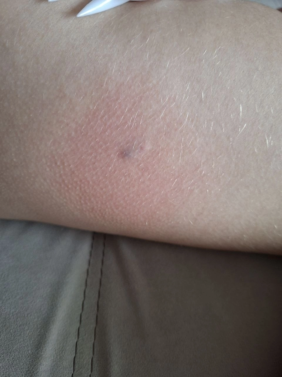 нападение собаки 