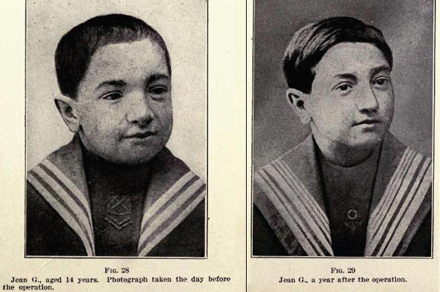 14-летний мальчик после прививки щитовидной железы обезьяны; и тот же мальчик в возрасте 15 лет. Из книги Сергея Воронова «Жизнь. Изучение способов восстановления» (1920) 
