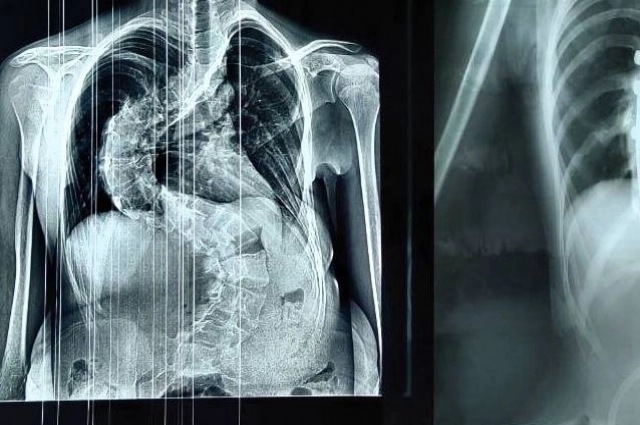 У школьницы была тяжелейшая форма грудопоясничного сколиоза