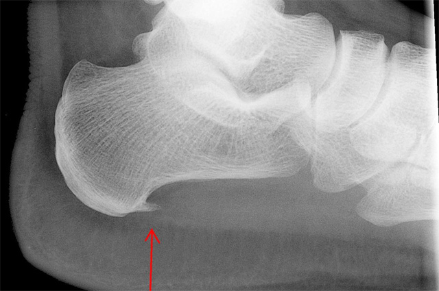 Краевой остеофит пяточной кости (пяточная шпора) на рентгенограмме стопы