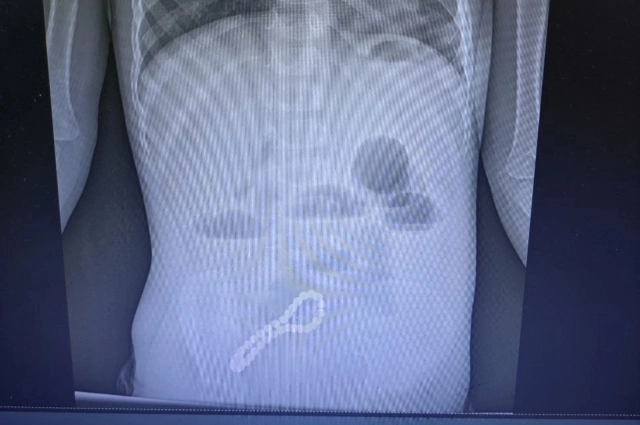 Рентгеновский снимок сразу показал наличие инородного тела в организме малыша.