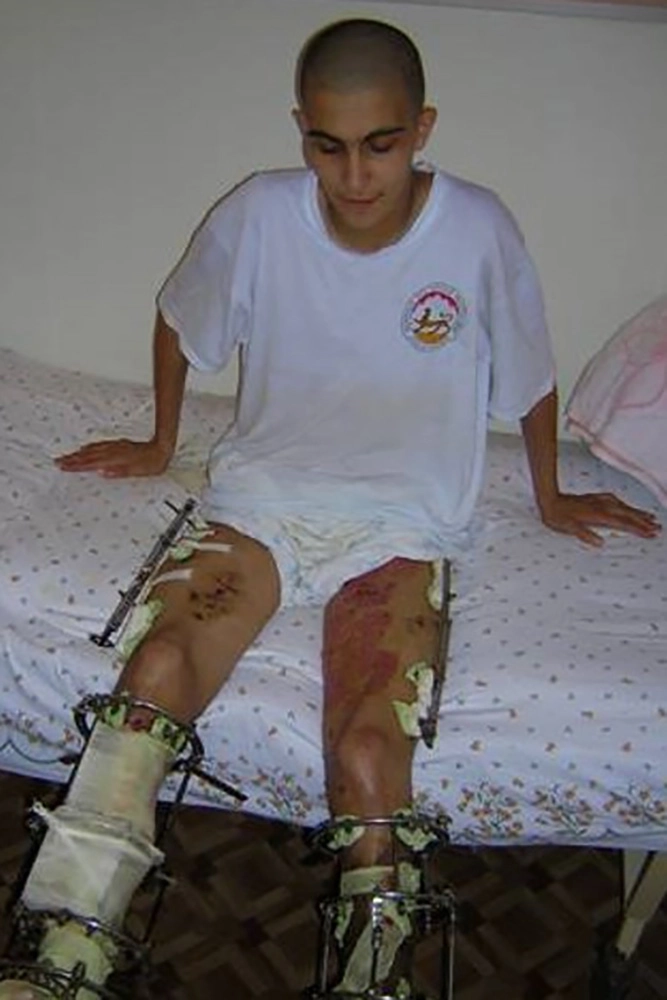 Этому пациенту грозил летальный исход, а в лучшем случае – ампутация обеих ног. Но через много лет он пригласил хирурга на свою свадьбу и танцевал на своих двоих. 