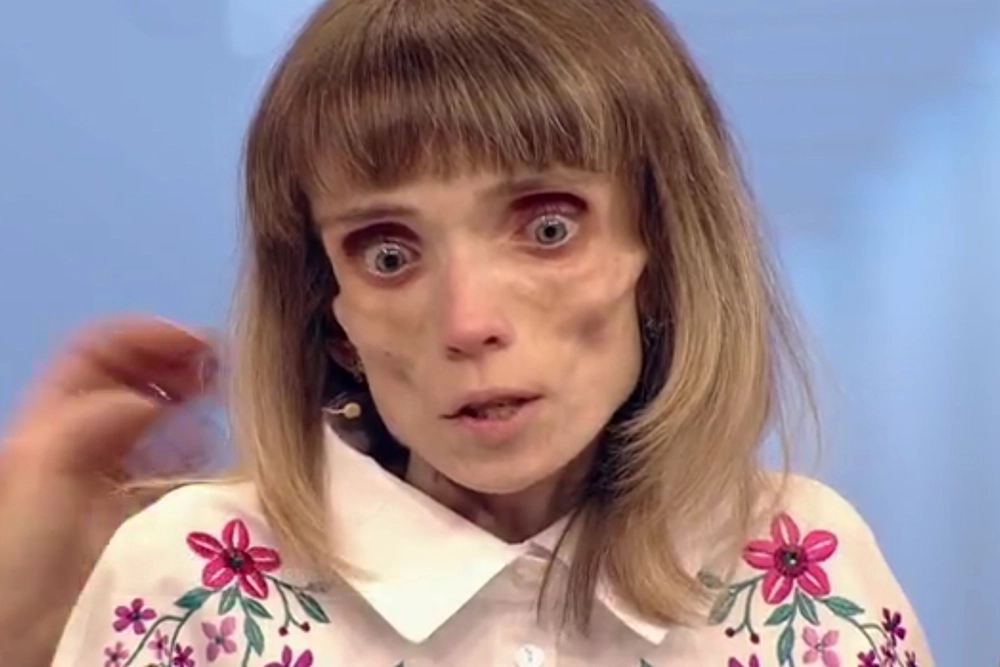 «Даже пить не могу». Куда пропала Кристина Корягина, которая весила 17 кг