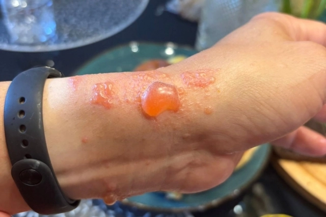 Симптомы — зуд и жжение — могут проявиться не сразу, а в течение нескольких дней