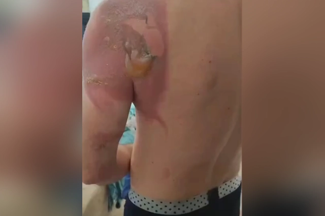 Сначала мужчина ничего не почувствовал, волдыри вышли на следующий день.