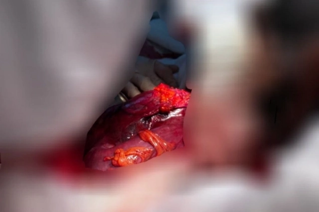 Вес опухали составил пять килограммов.