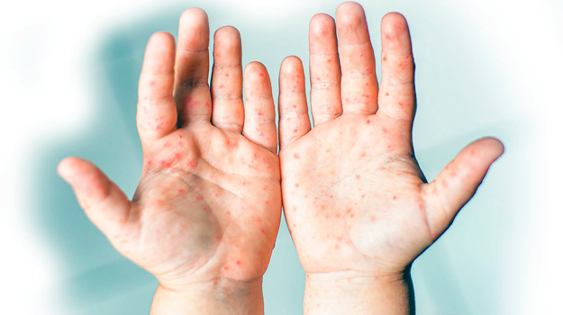 Энтеровирус проявляется по-разному: от сыпи до симптомов ангины.