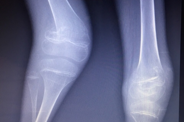 На рентгене врачи увидели у Стёпы перелом обеих ног.