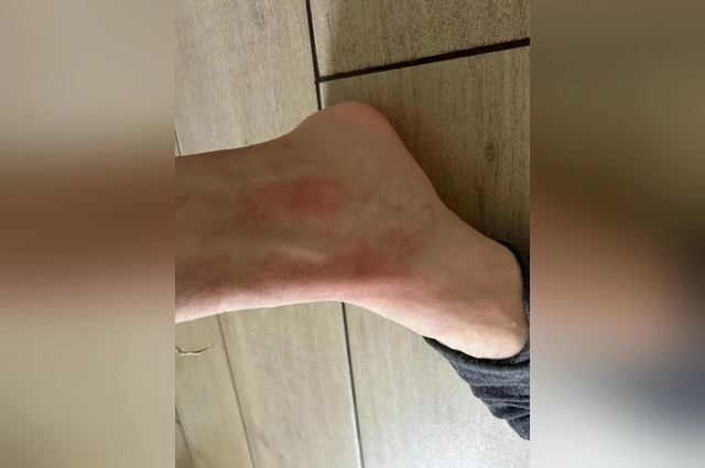 Из-за воды на коже высыпают покраснения.