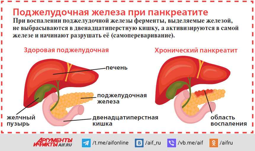 Панкреатит поджелудочной железы. Лекарство от панкреатита поджелудочной железы. Капельницы для поджелудочной железы при панкреатите. Таблетки от панкреатита поджелудочной железы.